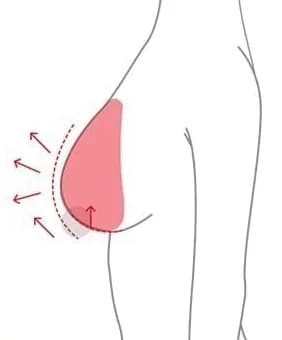 Hình thể hiện hướng gom và nâng mô để tạo lại hình dáng