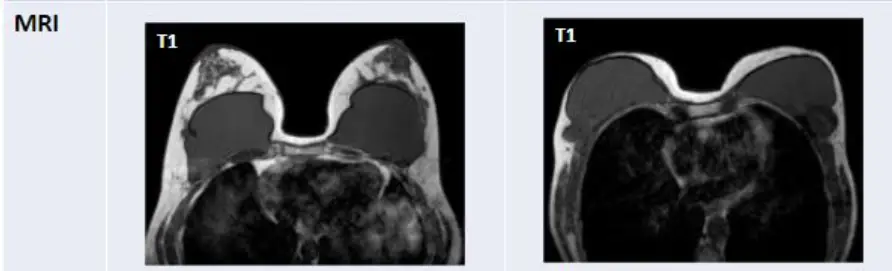 Túi ngực bị vỡ, có nhất thiết phải chụp MRI? Liệu có thể kiểm tra bằng siêu âm không? — hình ảnh bài viết 6