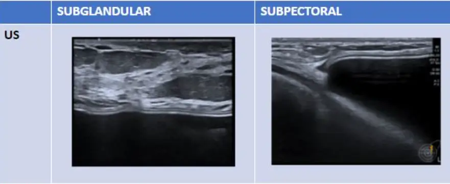 Túi ngực bị vỡ, có nhất thiết phải chụp MRI? Liệu có thể kiểm tra bằng siêu âm không? — hình ảnh bài viết 5