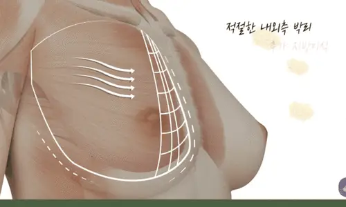 Phẫu thuật ngực ức gà: liệu nâng ngực xong có bị to ra mà không có khe ngực? <Lời khuyên từ 20 năm kinh nghiệm nghiên cứu> — 본문 이미지