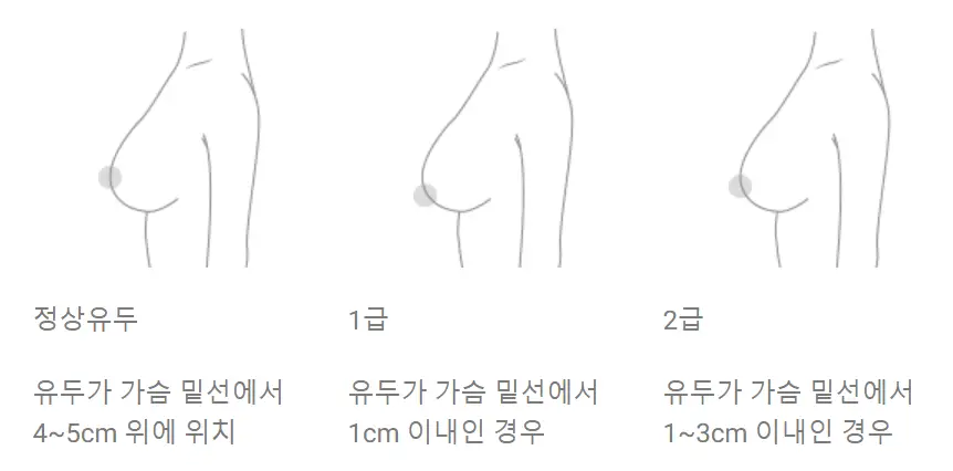 Chi phí phẫu thuật treo ngực sa trễ? Lý do biết giá trước cũng vô nghĩa. — hình ảnh bài viết 3