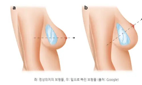 Phẫu thuật chỉnh sửa túi tụt xuống dưới nếp chân ngực? Tổng hợp phương pháp theo đường mổ nách/nếp chân ngực <Lời khuyên từ 20 năm kinh nghiệm nghiên cứu> — 본문 이미지