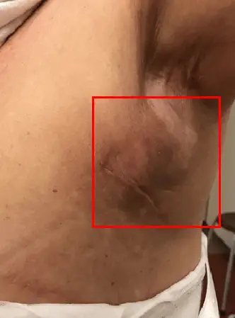 Thời gian hồi phục sau phẫu thuật ngực — 2 biến chứng có thể kéo dài thêm hơn 1 tuần <Lời khuyên từ 20 năm kinh nghiệm nghiên cứu> — 본문 이미지