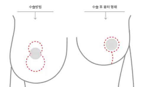 Chi phí phẫu thuật ngực chảy xệ — kèm tổng hợp các trường hợp cần treo ngực / túi độn. <Lời khuyên từ 20 năm kinh nghiệm nghiên cứu> — hình ảnh bài viết 5