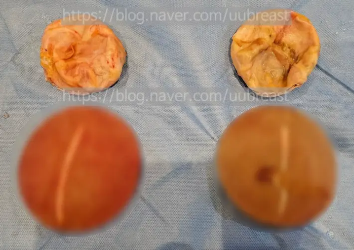 Phẫu thuật cắt bỏ bao xơ? Về trường hợp chi phí có thể chênh lệch khoảng 2 lần <Lời khuyên từ 20 năm kinh nghiệm nghiên cứu> — 본문 이미지