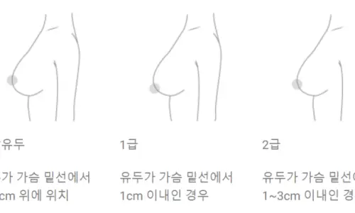 Review phẫu thuật ngực chảy xệ? Đừng để bị đánh lừa. — hình ảnh bài viết 12