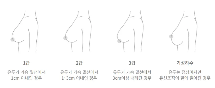 Ngực chảy xệ sau sinh — lầm tưởng rằng chỉ cần lấp đầy phần ngực trên bằng túi độn? — hình ảnh bài viết 6