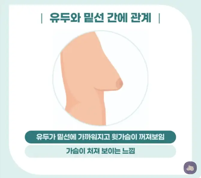 Chi phí phẫu thuật ngực chảy xệ? Đừng vội tin cả những bài review. — hình ảnh bài viết 4