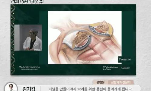 Chi phí Motiva Preservé: nếu bạn mong muốn kích cỡ như thế này, hãy cân nhắc cả phương pháp khác. <Lời khuyên từ 20 năm kinh nghiệm nghiên cứu> — 본문 이미지