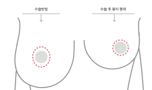 Chi phí phẫu thuật ngực chảy xệ — kèm tổng hợp các trường hợp cần treo ngực / túi độn. <Lời khuyên từ 20 năm kinh nghiệm nghiên cứu> — hình ảnh bài viết 6
