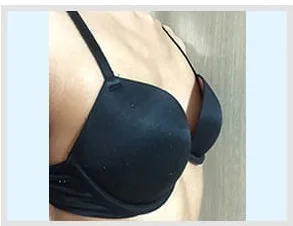 Ảnh nghiêng trước nâng ngực 3