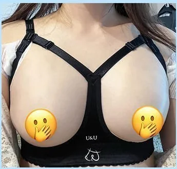 Ngày thứ 2 sau nâng ngực, ảnh chính diện mặc áo định hình 1