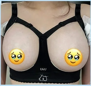 Ngày thứ 2 sau nâng ngực, ảnh chính diện mặc áo định hình 2