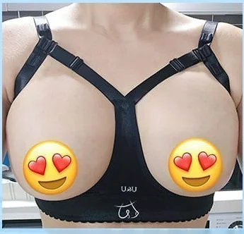 Ngày thứ 2 sau nâng ngực, ảnh chính diện mặc áo định hình 6