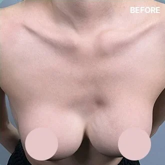 Ảnh phần trên ngực trước khi cải thiện gợn sóng