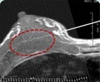 Ảnh CT nhìn nghiêng của ngực — đánh dấu vị trí tiêm