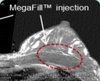 MegaFill™ injection — ảnh CT nhìn nghiêng của ngực đánh dấu vị trí cấy ghép