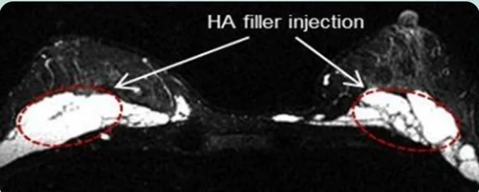 HA filler injection — ảnh MRI mặt cắt ngang hai bên ngực đánh dấu vị trí tiêm filler