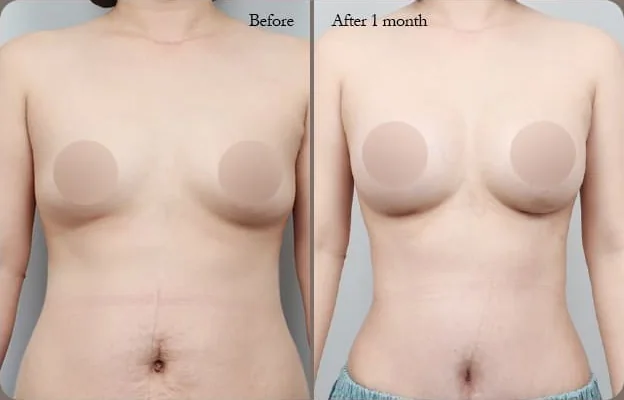 Ảnh so sánh chính diện 1 — trước và 1 tháng sau nâng đồng thời ngực và bụng