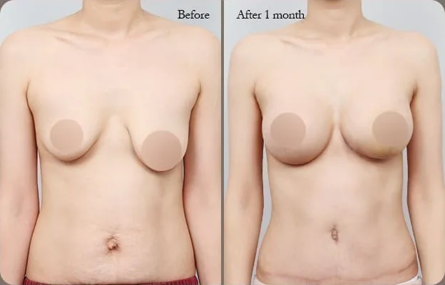 Ảnh so sánh chính diện 3 — trước và 1 tháng sau nâng đồng thời ngực và bụng
