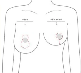 Sơ đồ nửa thân trên thể hiện vị trí rạch dọc và hình dạng sẹo sau mổ