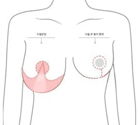 Sơ đồ nửa thân trên thể hiện phạm vi rạch chữ O và hình dạng sẹo sau mổ