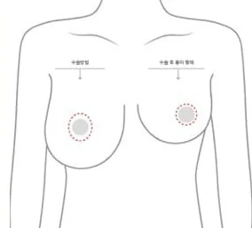 Sơ đồ nửa thân trên thể hiện vị trí rạch quầng vú và hình dạng sẹo sau mổ