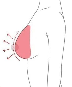 Sơ đồ nhìn nghiêng của nâng ngực chỉ đặt túi độn để lấp đầy thể tích