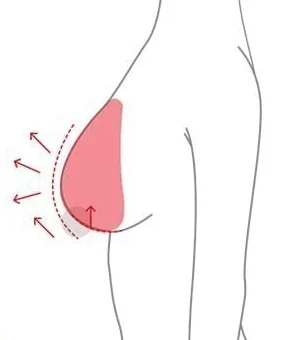Sơ đồ nhìn nghiêng của treo ngực nâng vị trí núm vú cùng với đặt túi độn