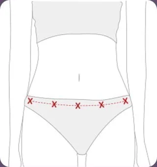 Sơ đồ đánh dấu đường khâu ngang tầm xương chậu, phía trong đường bikini