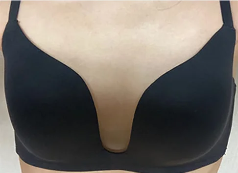 Ảnh trước khi nâng ngực 7