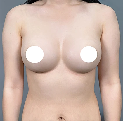 Sau nâng ngực 1
