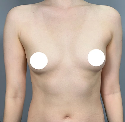 Trước nâng ngực 1