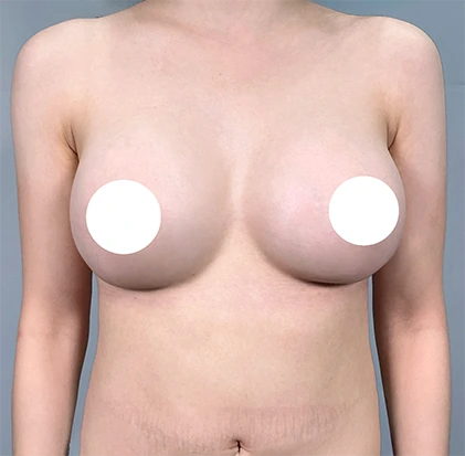 Sau nâng ngực 3