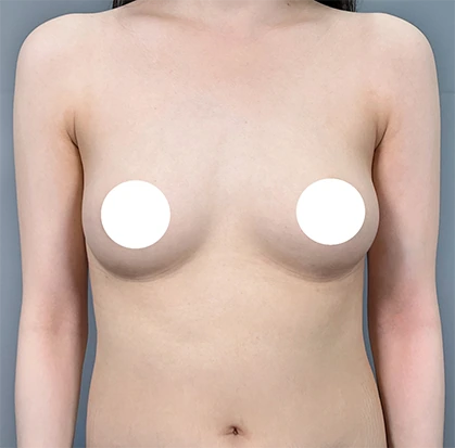 Trước nâng ngực 3