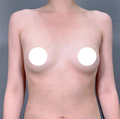 Trước nâng ngực 4