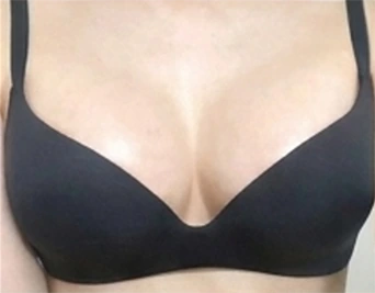 Ảnh mặc áo ngực sau nâng ngực 1