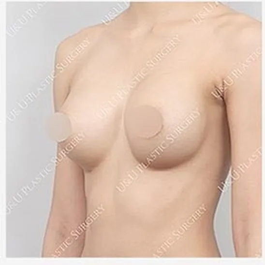 Ảnh nghiêng trước tái phẫu thuật một bên ngực 3