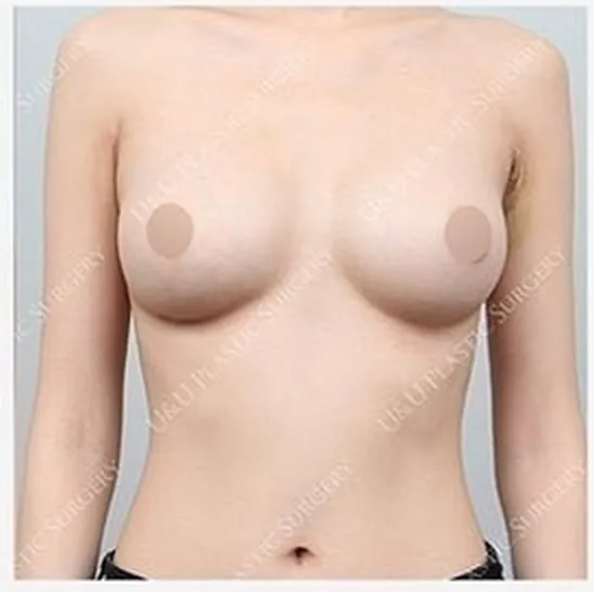 Ảnh sau tái phẫu thuật một bên ngực 5
