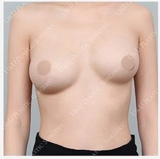 Ảnh trước tái phẫu thuật một bên ngực 5
