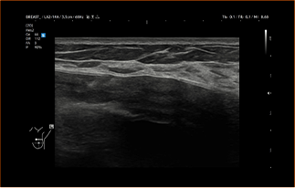 Healthy Breast siêu âm túi độn img10 m