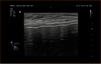 Healthy Breast siêu âm túi độn img11 m