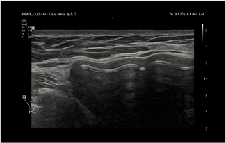 Healthy Breast siêu âm túi độn img6 m