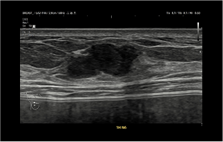 Healthy Breast siêu âm ung thư vú img10 m