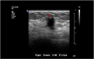 Healthy Breast siêu âm ung thư vú img11 m