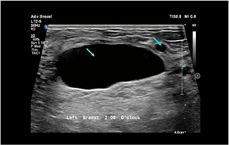 Healthy Breast siêu âm ung thư vú img12 m