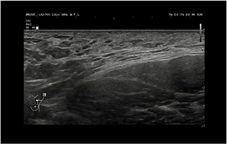 Healthy Breast siêu âm ung thư vú img13 m
