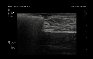 Healthy Breast siêu âm ung thư vú img14 m