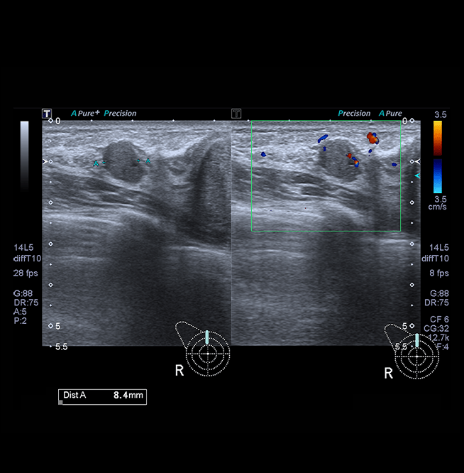 Healthy Breast siêu âm ung thư vú img17 m