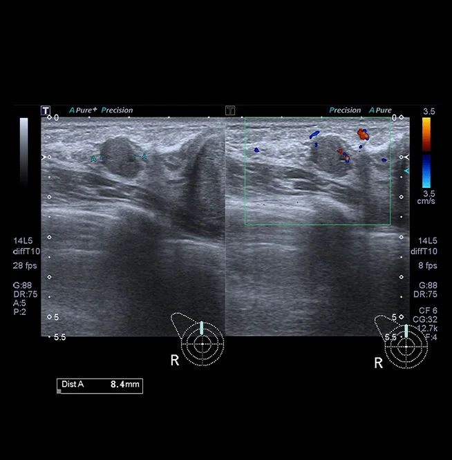 Healthy Breast siêu âm ung thư vú img17 m
